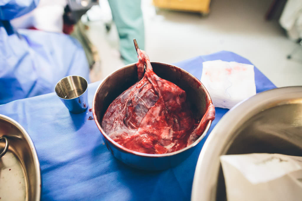 a clamped placenta in a bowl after birth
