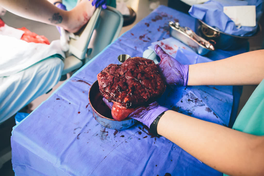 midwife examines placenta in a bowl